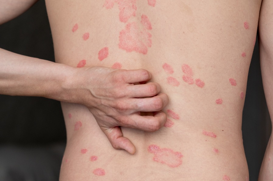 El impacto oculto de la psoriasis: más allá de una enfermedad en la piel