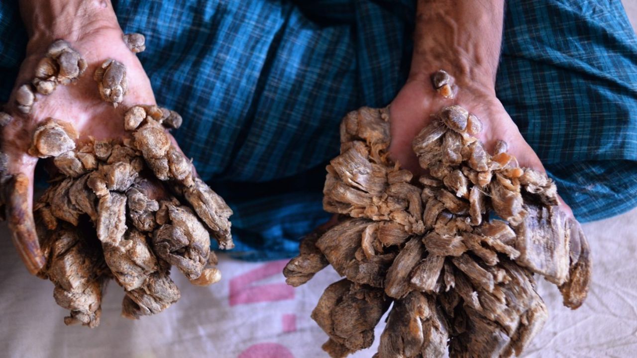 Síndrome del hombre árbol: la rara enfermedad que transforma la piel en ‘corteza’